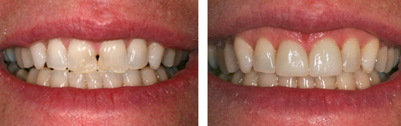 Dental patient before after Images