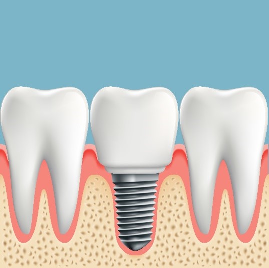 Dental Implants for La Grange/Highlands/Park, IL